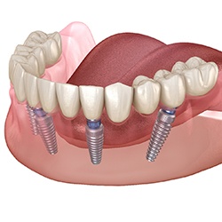 All-on-4 denture on lower arch 